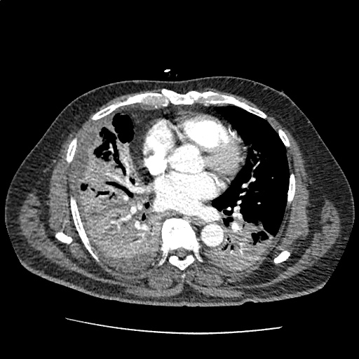 Differential Diagnosis of Pleural Effusion