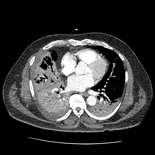 Differential Diagnosis of Pleural Effusion