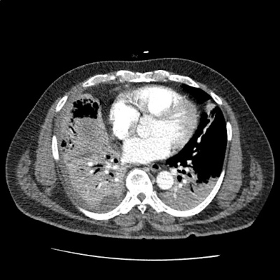 pna_15 - Differential Diagnosis of