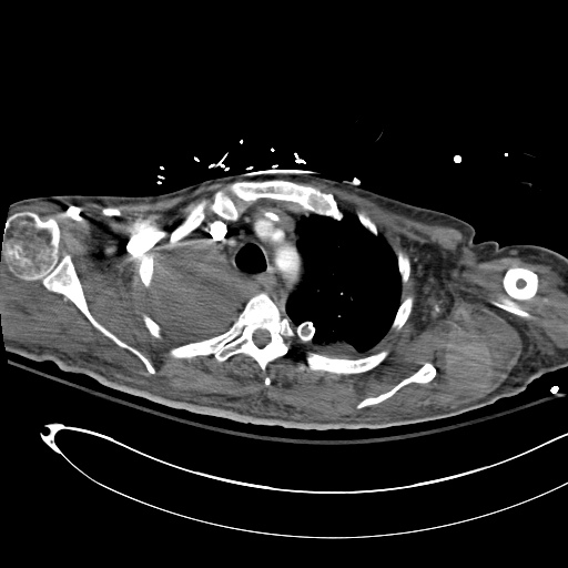 Pleural Effusion, Pulmonary Embolism