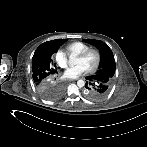 Differential Diagnosis of Pleural Effusion