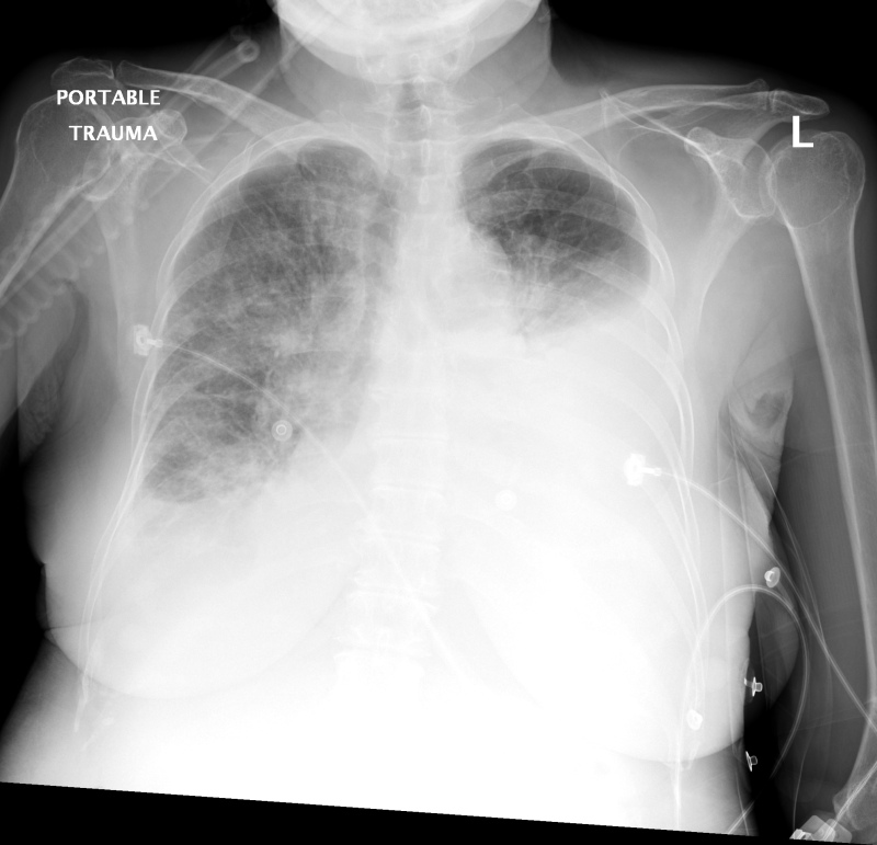 Unilateral Pleural Effusion Differential