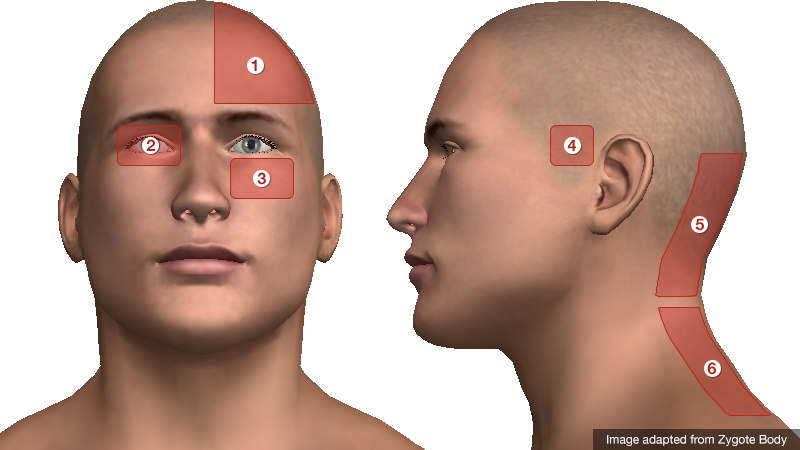 Headache Chart Top Of Head 191814 What Does A Headache On The Top Of   Headache Location 