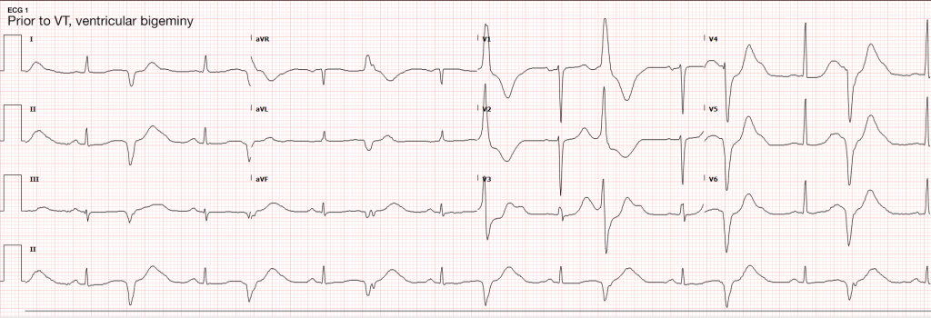 ECG 1