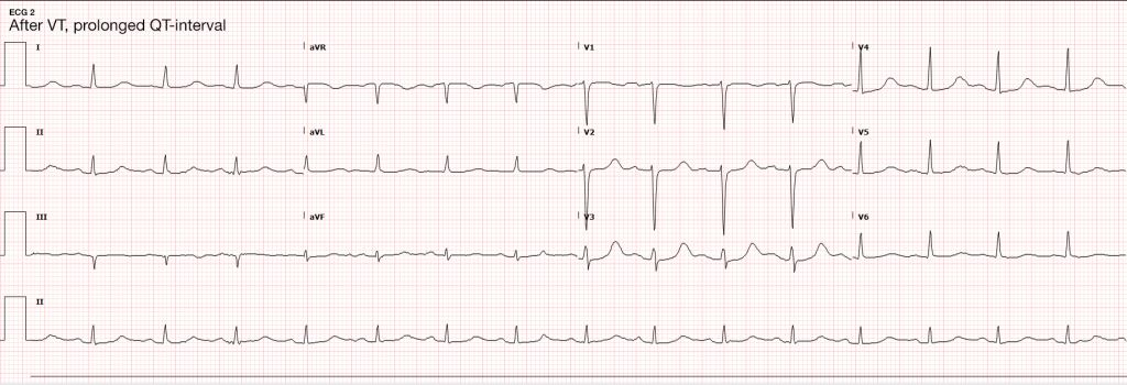 ECG 2