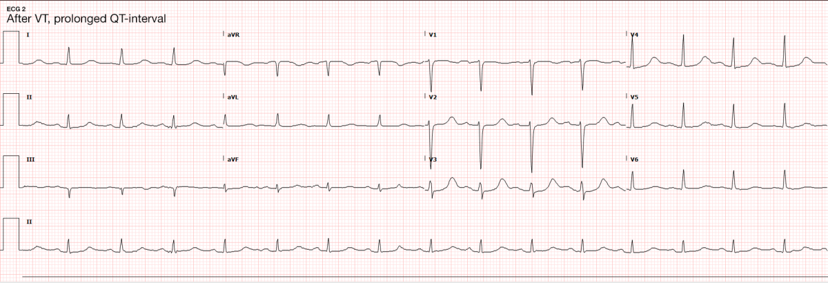 ECG 2 - Differential Diagnosis of