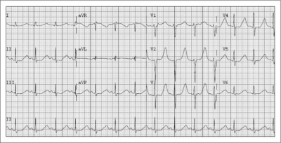 ECG: U-wave - Differential Diagnosis of