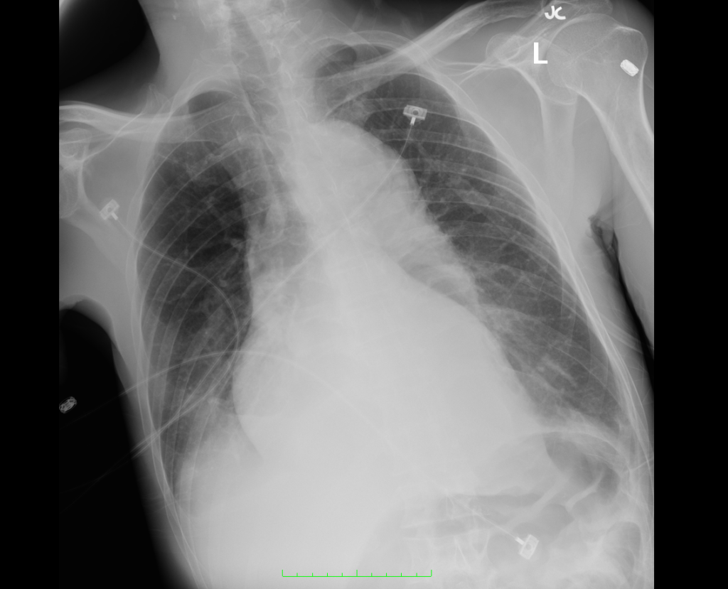 Prominent cardiomediastinal silhouette, which may be due to patient position.