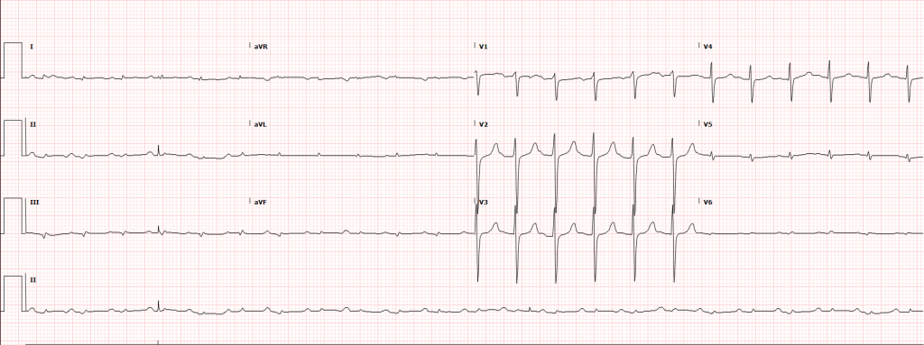 Low Voltage ECG