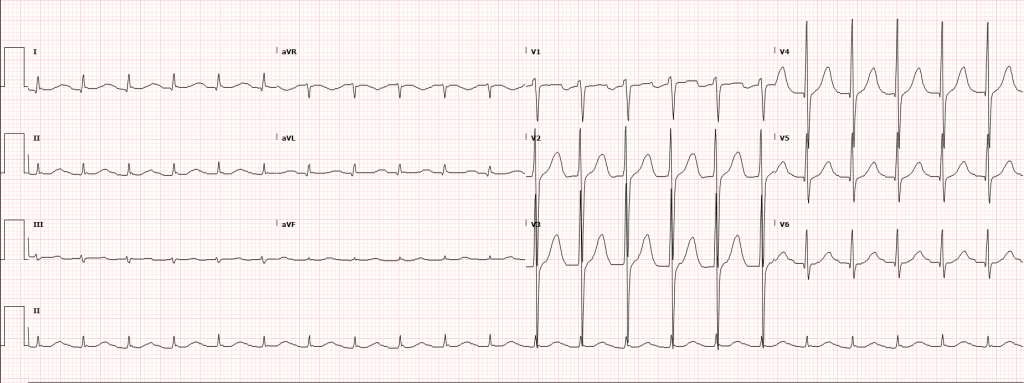 Low Qrs Voltage In Precordial Leads Meaning