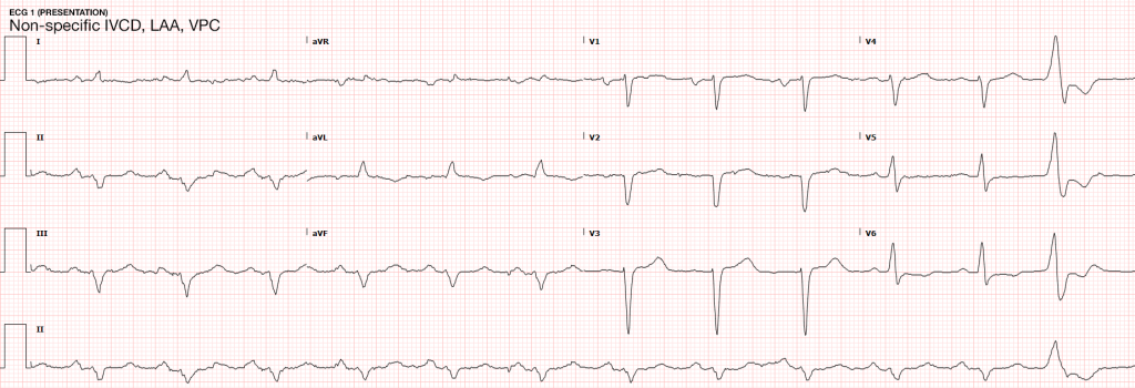 ECG 1