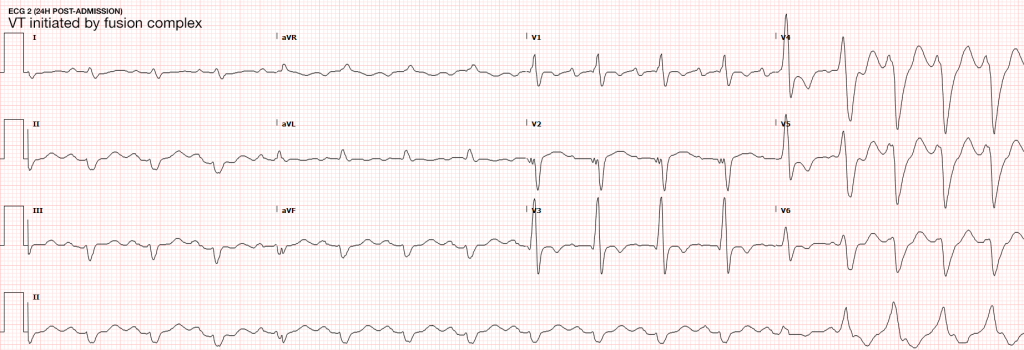 ventricular tachycardia ecg