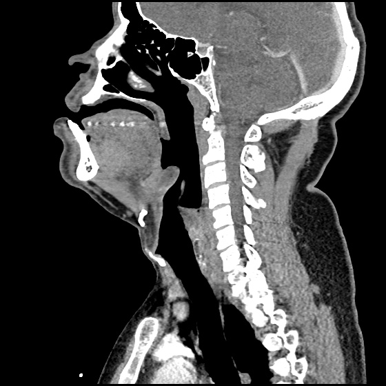 Epiglottitis