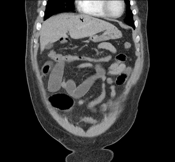 portal_venous_gas_0000_Layer-Comp-1