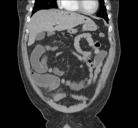 Differential Diagnosis of Portal Venous Gas