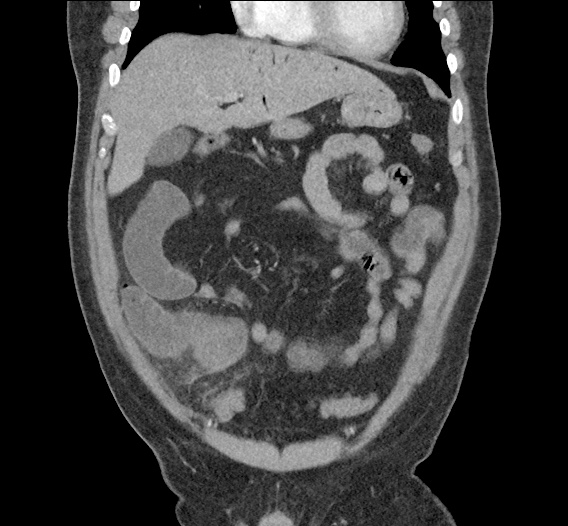 Differential Diagnosis of Portal Venous Gas