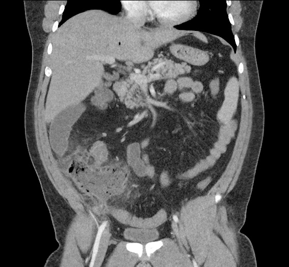 Differential Diagnosis of Portal Venous Gas