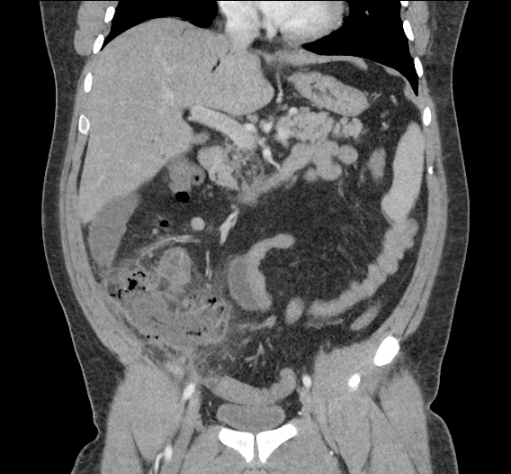 Differential Diagnosis Of Portal Venous Gas