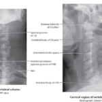 C-spine Radiographs