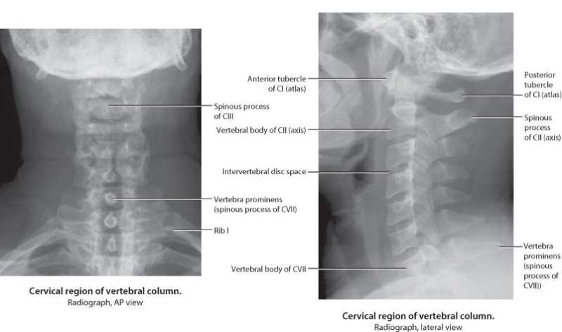 C-spine Radiographs - Differential Diagnosis of