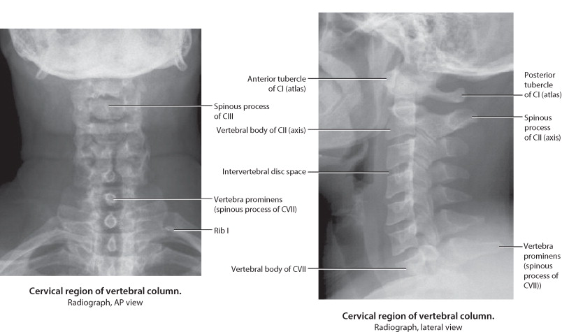 cervical spine fracture x rays