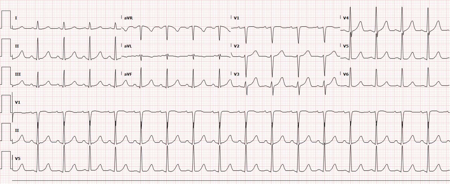 Ventricular Tachycardia s Differential Diagnosis Of