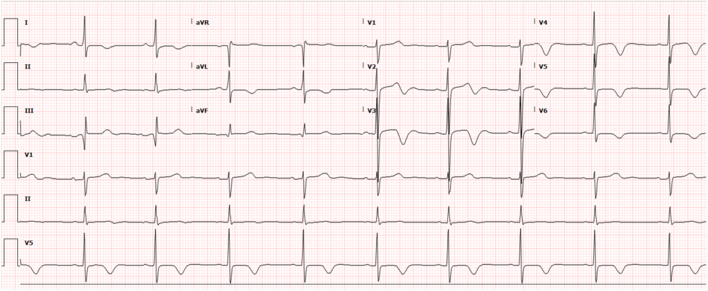 Presentation ECG