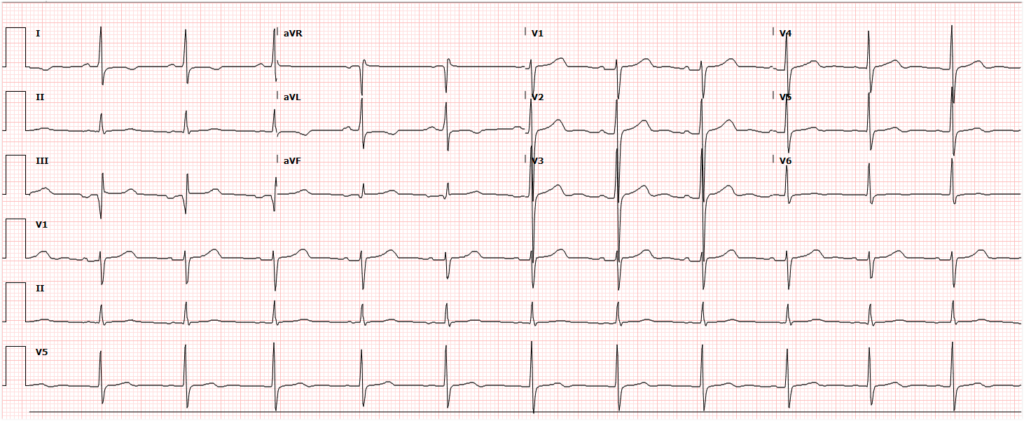 Post-Catheterization ECG