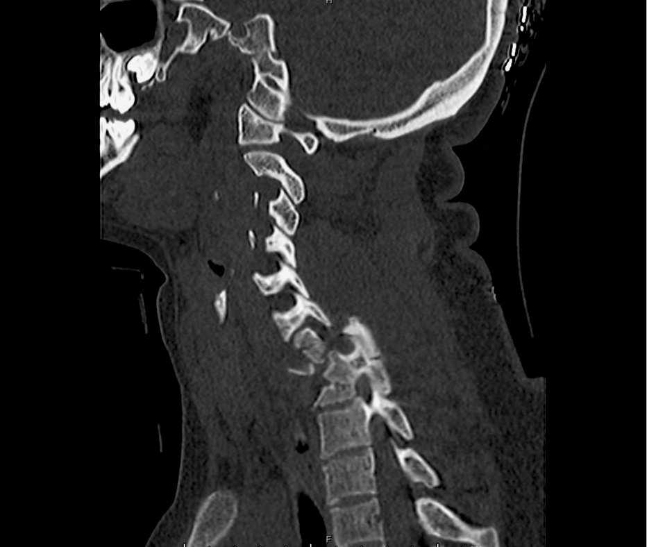 Differential Diagnosis of Cervical Spine Injuries