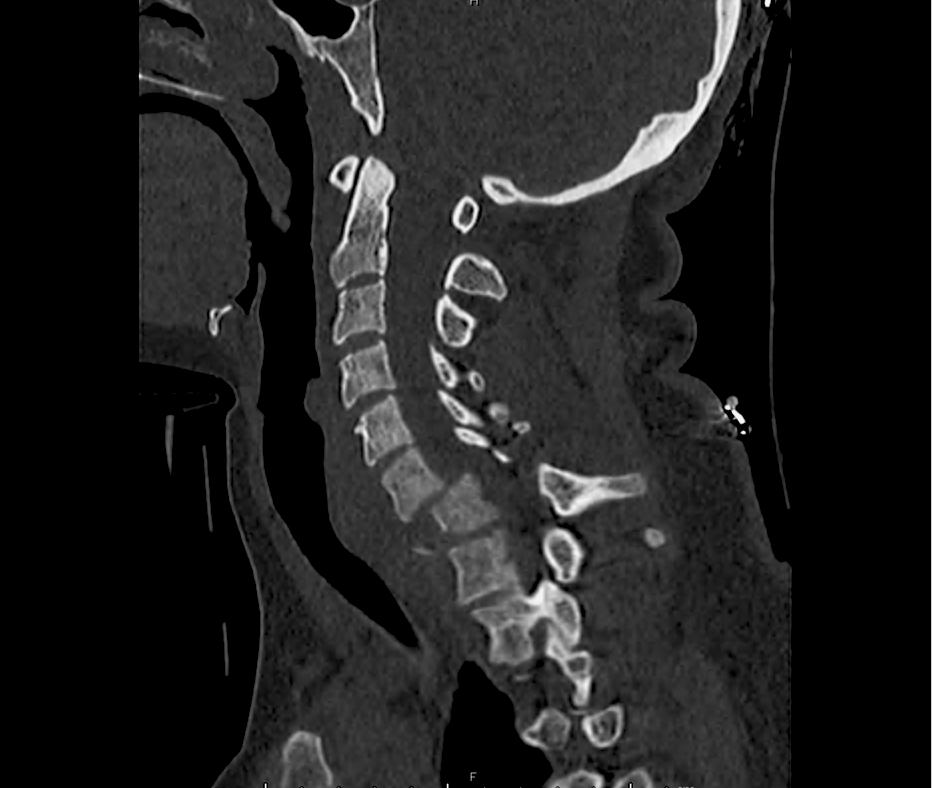 c-spine_10