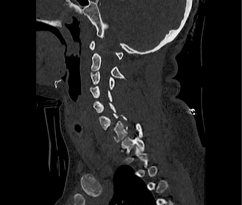 c-spine_13