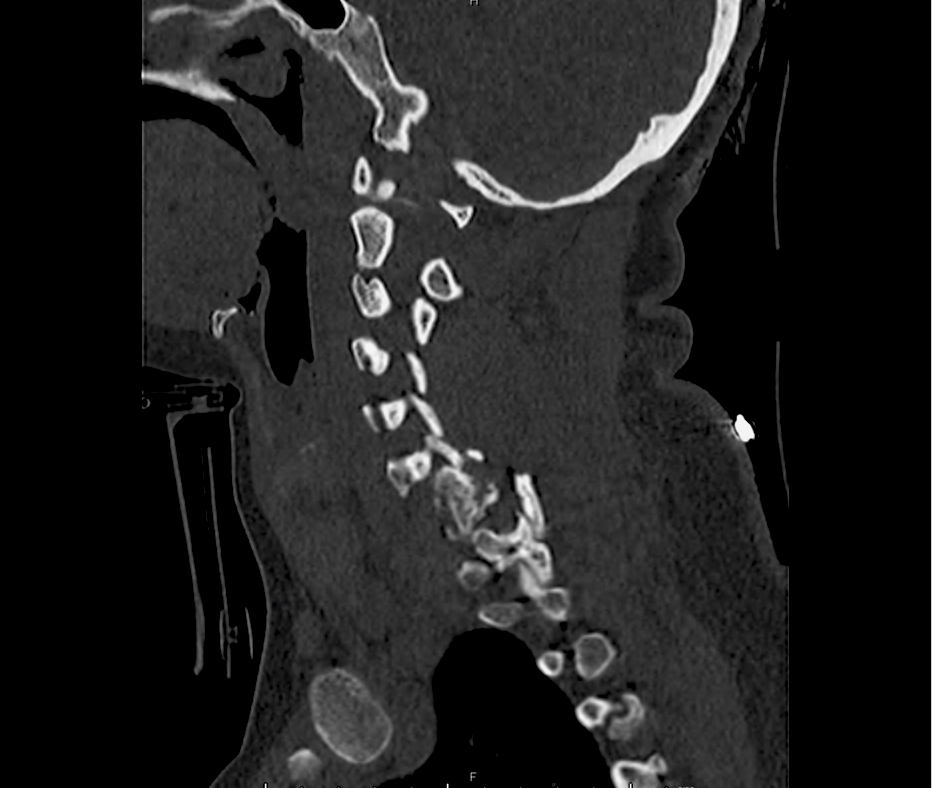 c-spine_14