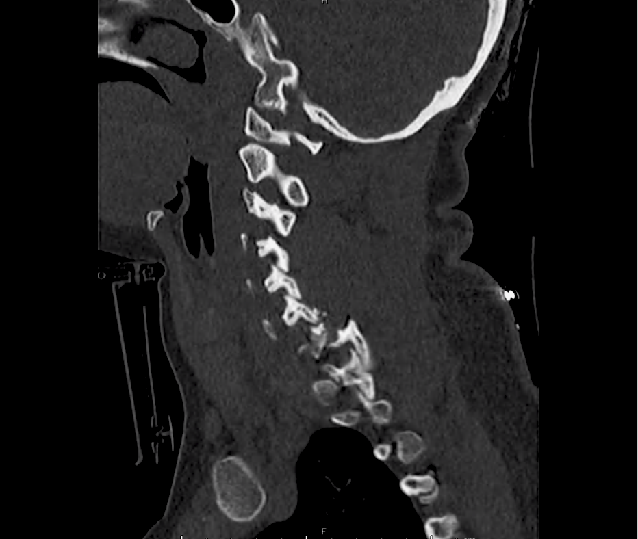 c-spine_15