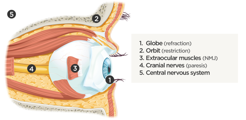 Sites causing diplopia