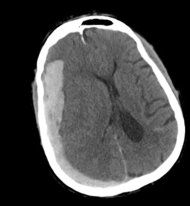 Differential Diagnosis of Head Trauma: Radiographic Evolution