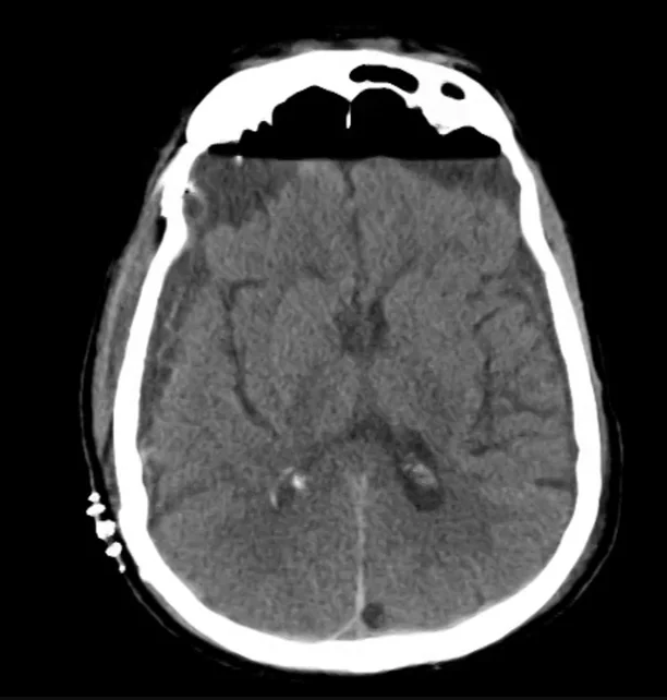 CT Head (+16h, s/p SDH evacuation)