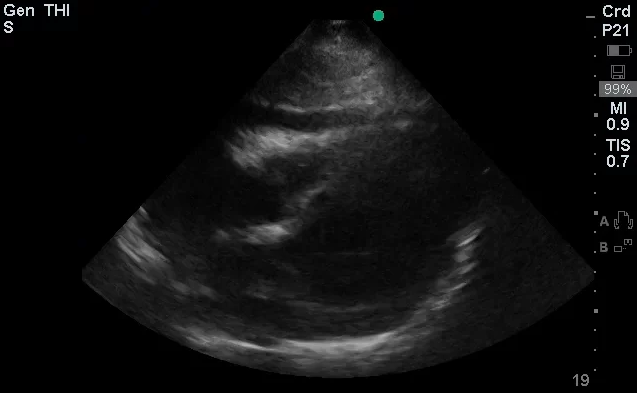 Pericardial Effusion - Subxiphoid