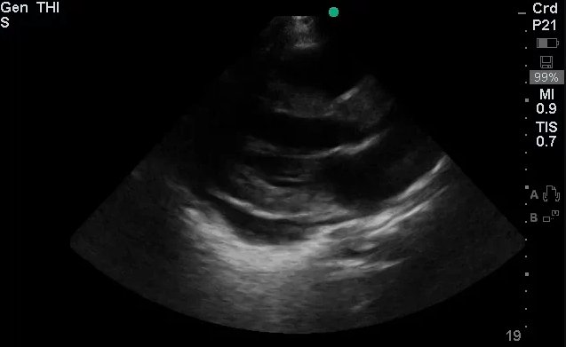 Pericardial Effusion - Parasternal Long