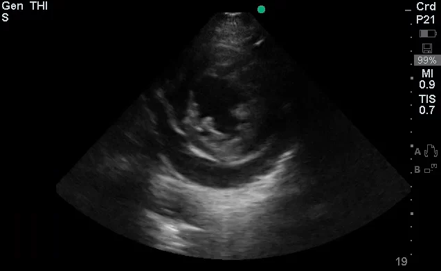 Pericardial Effusion - Parasternal Short