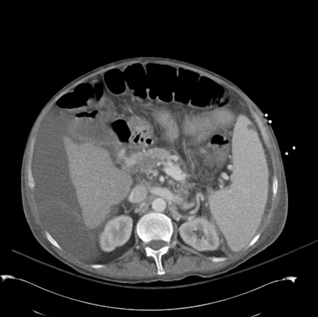 CT Abdomen/Pelvis (PVT)