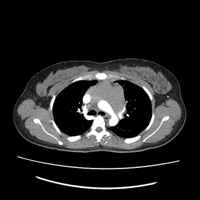 CT Chest - Axial