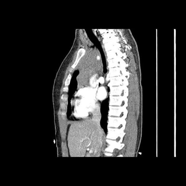 CT Chest - Sagittal