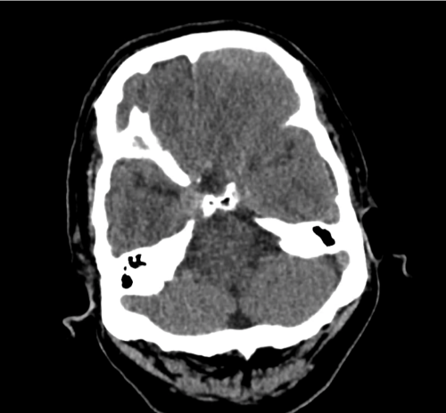 ct-sdh_01 - Differential Diagnosis of