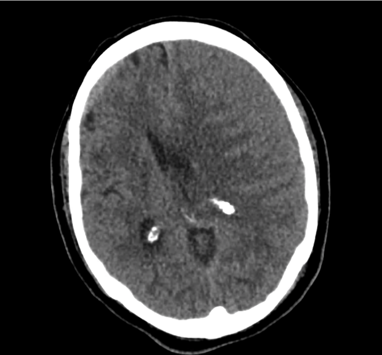 ct-sdh_09 - Differential Diagnosis of