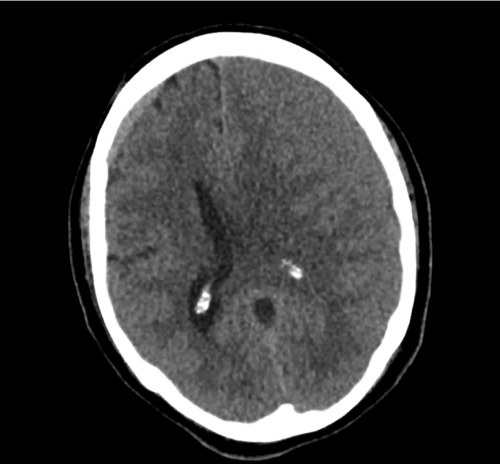 ct-sdh_10 - Differential Diagnosis of