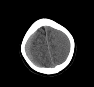 ct-sdh_18 - Differential Diagnosis of