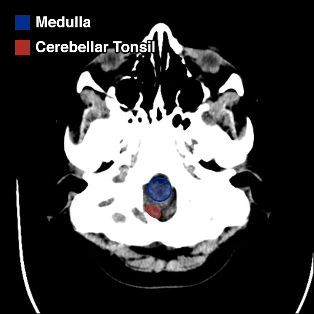 Brainstem