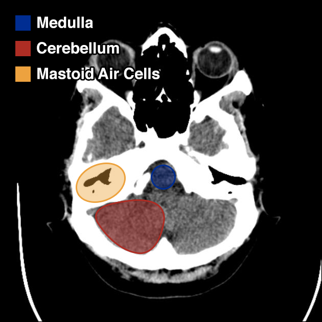 Posterior Fossa