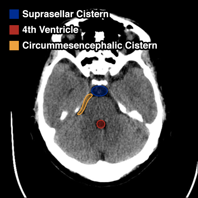 Suprasellar Cistern Anatomy