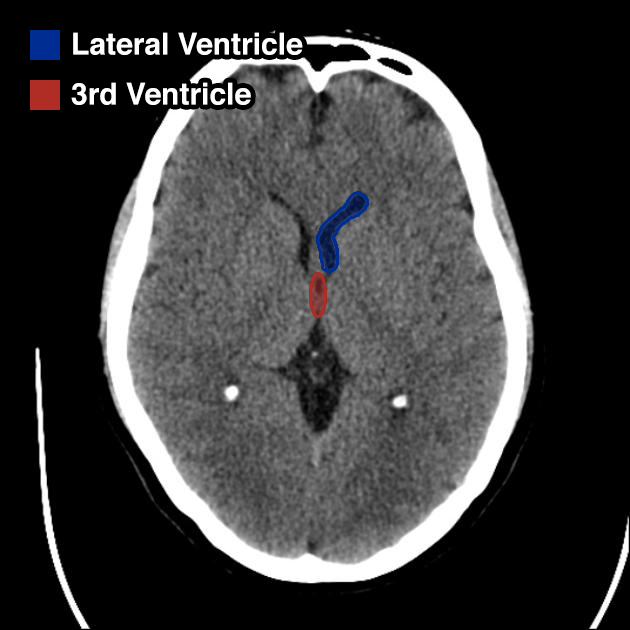 Ventricles